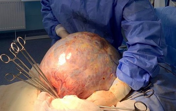 У Кропивницькому онкологи видалили пухлину вагою в 10 кг